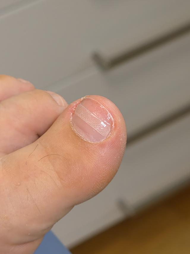 BS-Spange am großen Zeh