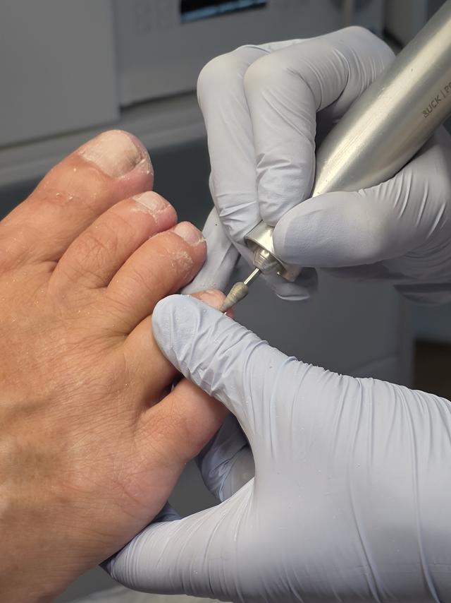 Podologische Fussbehandlung mit Fräser