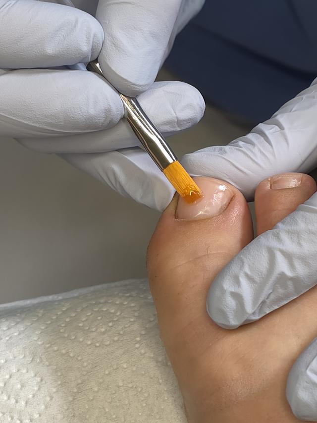 Teilnagelprothetik Behandlung mit Pinsel in der Praxis